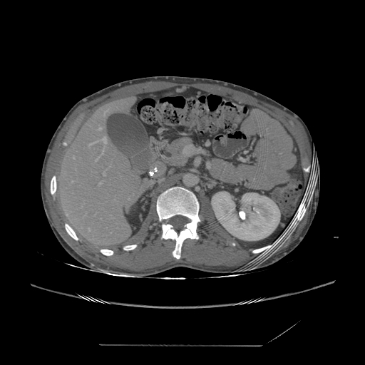 File:Chronic IVC thrombosis and resultant IVC filter malposition (Radiopaedia 81158-94800 A 66).jpg