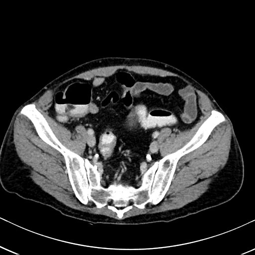 Chronic appendicitis complicated by appendicular abscess, pylephlebitis and liver abscess (Radiopaedia 54483-60700 B 116).jpg