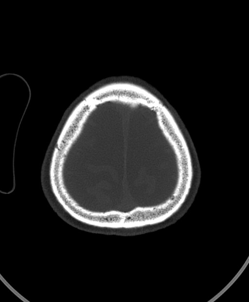 Chronic bilateral subdural hygroma (Radiopaedia 85801-101623 Axial bone window 23).jpg