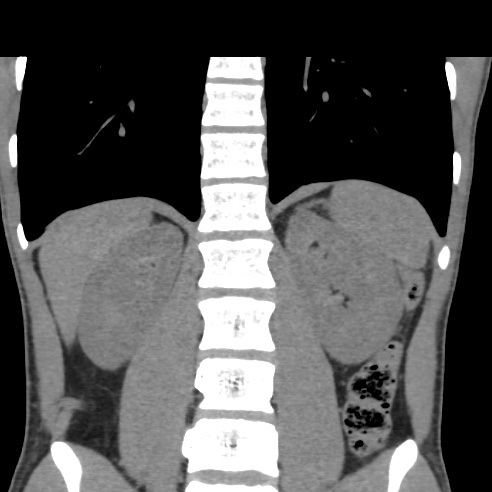 File:Chronic calcific pancreatitis (Radiopaedia 56280-62953 Coronal non-contrast 26).jpg