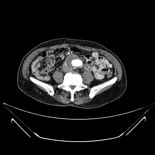 Chronic contained rupture of abdominal aortic aneurysm with extensive erosion of the vertebral bodies (Radiopaedia 55450-61901 A 43).jpg