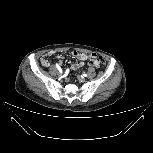 File:Chronic contained rupture of abdominal aortic aneurysm with extensive erosion of the vertebral bodies (Radiopaedia 55450-61901 A 58).jpg
