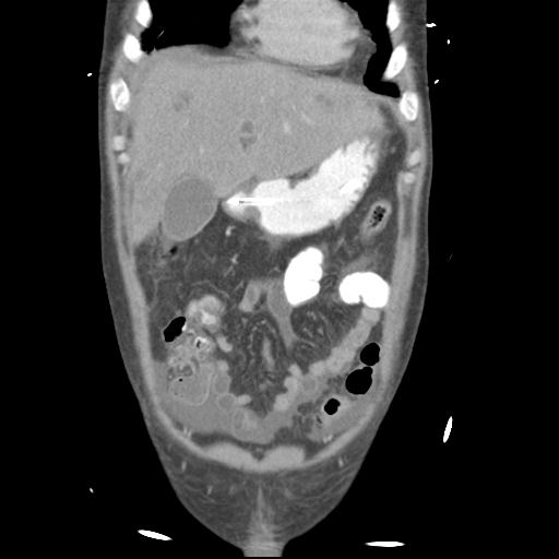 Chronic diverticulitis complicated by hepatic abscess and portal vein thrombosis (Radiopaedia 30301-30938 B 17).jpg