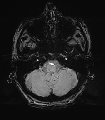 Chronic hypertensive encephalopathy (Radiopaedia 39993-42482 Axial SWI 15).png