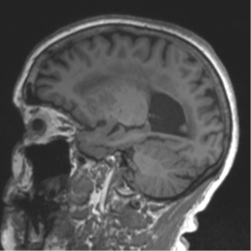 Chronic hypertensive encephalopathy (Radiopaedia 39993-42482 Sagittal T1 60).png