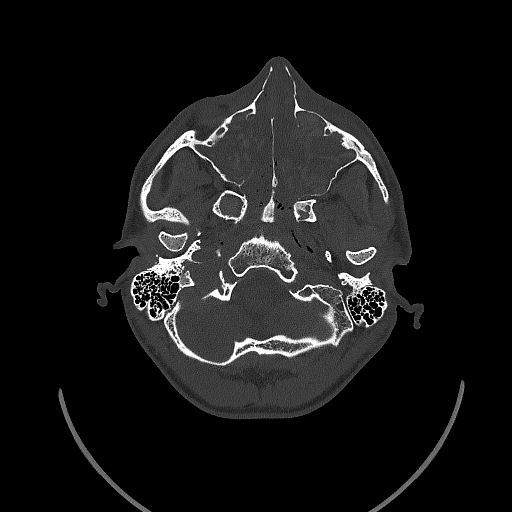 Chronic invasive fungal sinusitis (Radiopaedia 50342-55710 Axial bone window 42).jpg