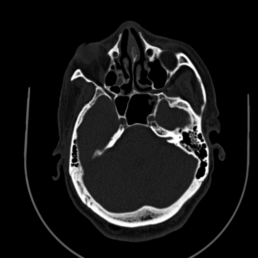 Chronic invasive fungal sinusitis (Radiopaedia 91563-109286 Axial sinus 57).jpg