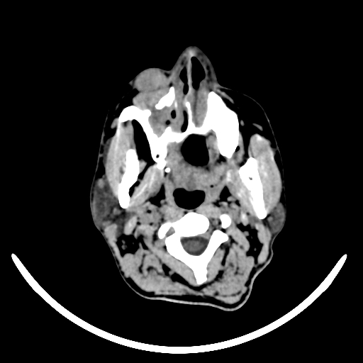 File:Chronic invasive fungal sinusitis with intraorbital and intracranial extension (Radiopaedia 56387-63046 Axial non-contrast 35).jpg