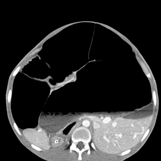 Chronic large bowel pseudo-obstruction (Radiopaedia 43181-46492 A 64).jpg