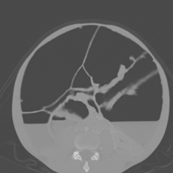 Chronic large bowel pseudo-obstruction (Radiopaedia 43181-46492 Axial bone window 106).jpg
