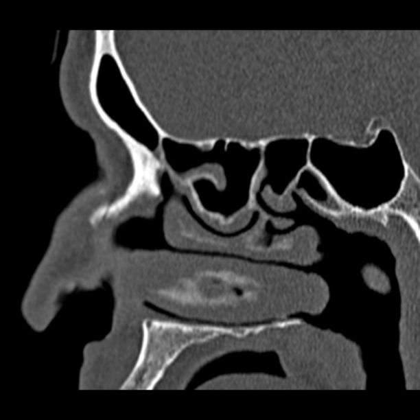 Chronic maxillary sinusitis (Radiopaedia 27879-28116 Sagittal bone window 22).jpg