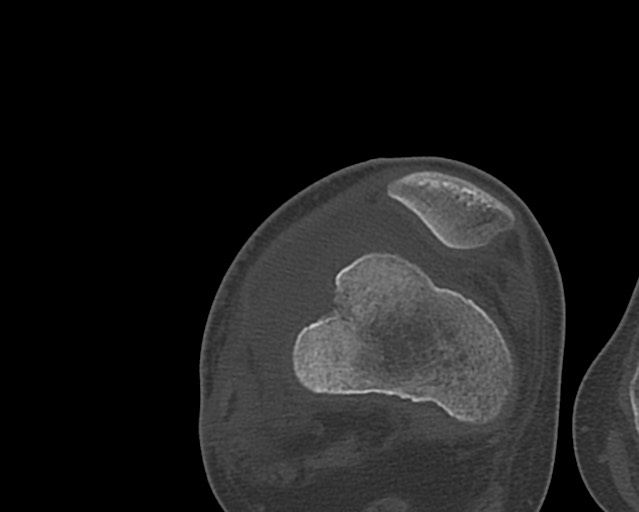 File:Chronic ostemyelitis of the femur with long sinus tract (Radiopaedia 74947-85982 Axial bone window 207).jpg