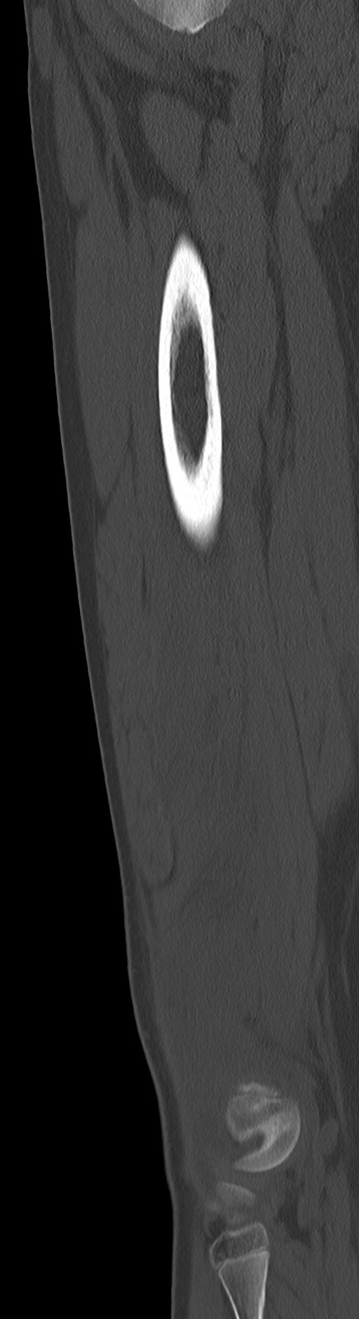 Chronic ostemyelitis of the femur with long sinus tract (Radiopaedia 74947-85982 Sagittal bone window 38).jpg