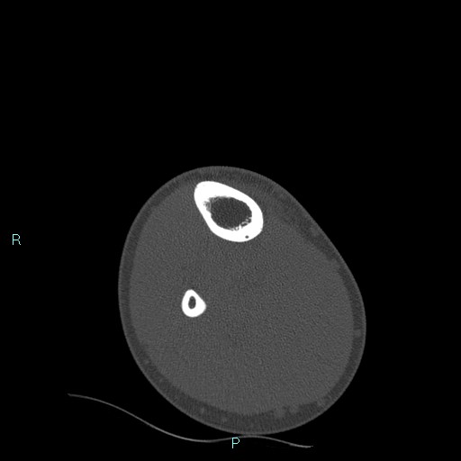 File:Chronic osteomyelitis (with Brodie abscess) (Radiopaedia 76405-88111 Axial bone window 12).jpg