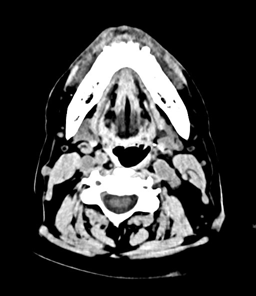 File:Chronic osteomyelitis - calvarial (severe) (Radiopaedia 69668-79616 Axial non-contrast 5).jpg