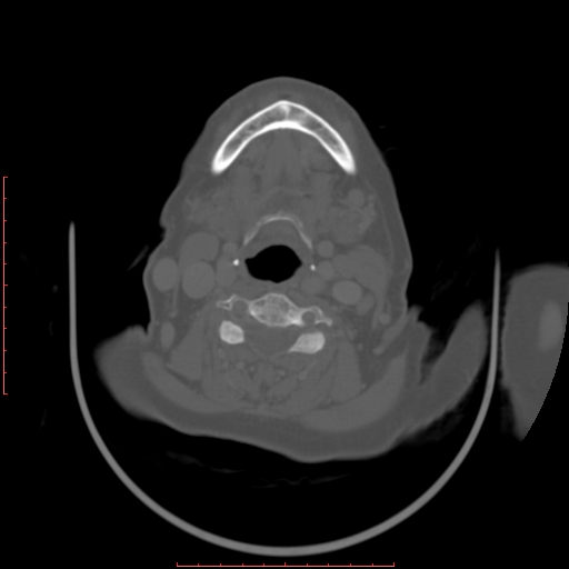 Chronic osteomyelitis - maxilla (Radiopaedia 23783-23927 Axial bone window 13).jpg