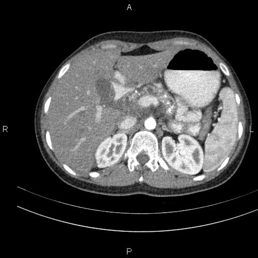 File:Chronic pancreatitis (Radiopaedia 64576-73450 B 37).jpg