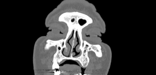 Chronic sphenoidal sinusitis (Radiopaedia 62030-70122 Coronal bone window 17).jpg