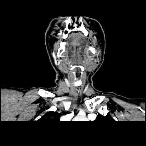 File:Chronic submandibular abscess (Radiopaedia 21738-21718 B 10).jpg