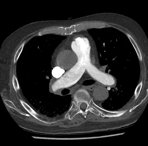 Chronic thromboembolic pulmonary disease (Radiopaedia 90694-108119 Axial C+ CTPA 46).jpg