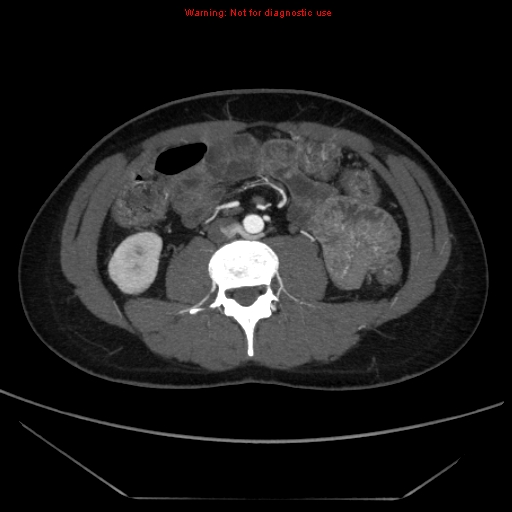 File:Circumaortic left renal vein (Radiopaedia 9069-9792 A 37).jpg