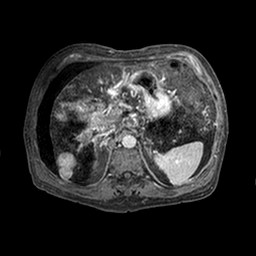 Cirrhosis and hepatocellular carcinoma in the setting of hemochromatosis (Radiopaedia 75394-86594 Axial T1 C+ fat sat 306).jpg