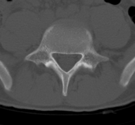 Clear cell meningoma - lumbar spine (Radiopaedia 60116-67691 Axial bone window 59).png