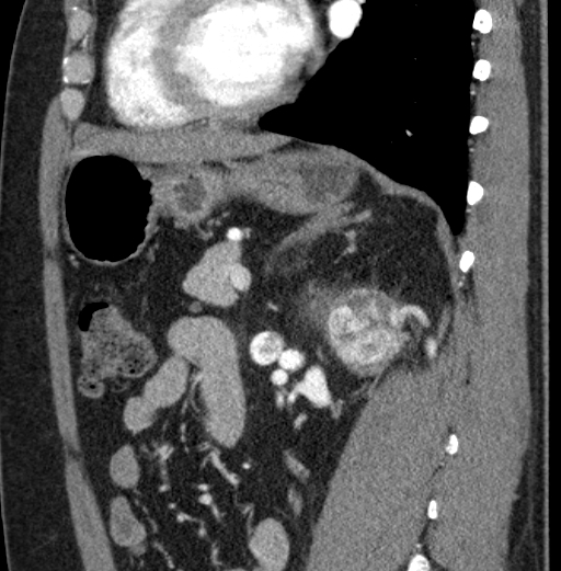 File:Clear cell renal cell carcinoma (Radiopaedia 61449-69393 D 39).jpg