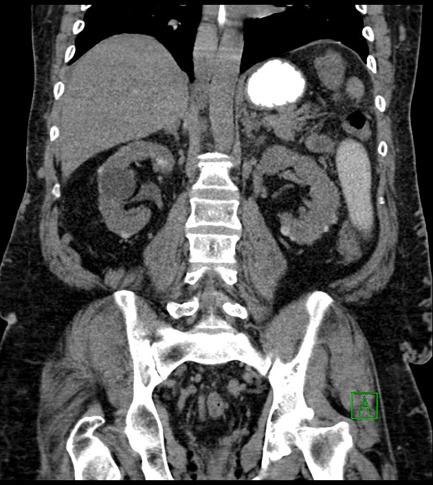 Closed-loop small bowel obstruction-internal hernia (Radiopaedia 78439-91096 Coronal non-contrast 67).jpg