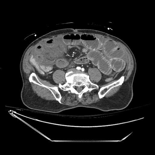 Closed loop obstruction due to adhesive band, resulting in small bowel ischemia and resection (Radiopaedia 83835-99023 B 98).jpg