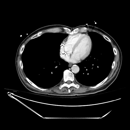 File:Closed loop obstruction due to adhesive band, resulting in small bowel ischemia and resection (Radiopaedia 83835-99023 D 11).jpg