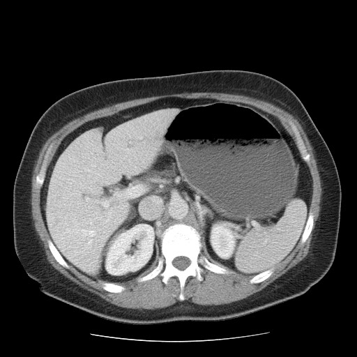 File:Closed loop small bowel obstruction (Radiopaedia 65403-74451 A 23).jpg