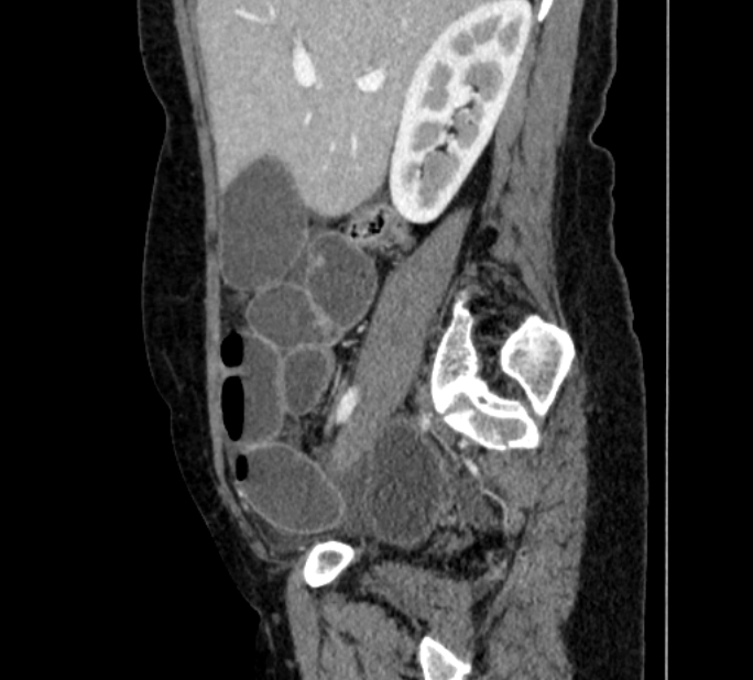 Closed loop small bowel obstruction (Radiopaedia 71211-81508 C 34).jpg