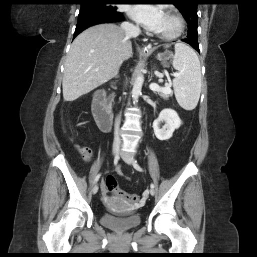Closed loop small bowel obstruction - internal hernia (Radiopaedia 65402-74450 B 61).jpg