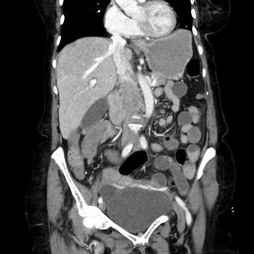 Closed loop small bowel obstruction due to adhesive band, with intramural hemorrhage and ischemia (Radiopaedia 83831-99017 C 57).jpg