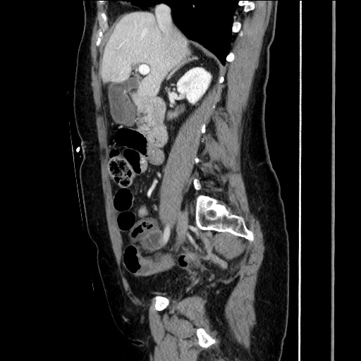 Closed loop small bowel obstruction due to adhesive bands - early and late images (Radiopaedia 83830-99014 C 74).jpg