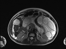 File:Closed loop small bowel obstruction in pregnancy (MRI) (Radiopaedia 87637-104031 Axial T2 26).jpg