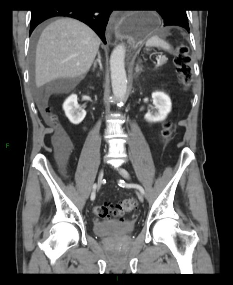 Closed loop small bowel obstruction with ischemia (Radiopaedia 84180-99456 B 28).jpg