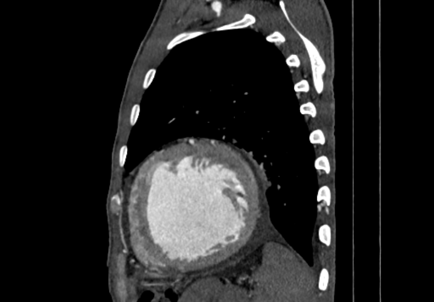 Coarctation of aorta with aortic valve stenosis (Radiopaedia 70463-80574 B 175).jpg