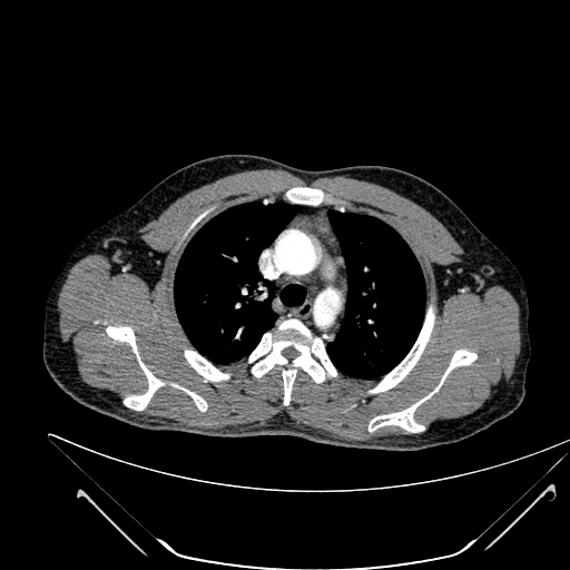 File:Coarctation of the aorta (Radiopaedia 49784-55050 B 60).jpg