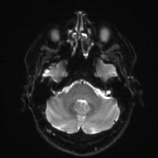 File:Cochlear incomplete partition type III associated with hypothalamic hamartoma (Radiopaedia 88756-105498 Axial DWI 10).jpg