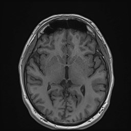 File:Cochlear incomplete partition type III associated with hypothalamic hamartoma (Radiopaedia 88756-105498 Axial T1 102).jpg