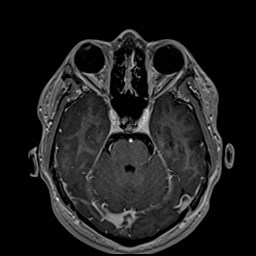 Cochlear incomplete partition type III associated with hypothalamic hamartoma (Radiopaedia 88756-105498 Axial T1 C+ 74).jpg