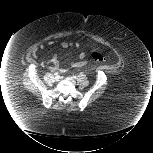 File:Collection due to leak after sleeve gastrectomy (Radiopaedia 55504-61972 A 59).jpg