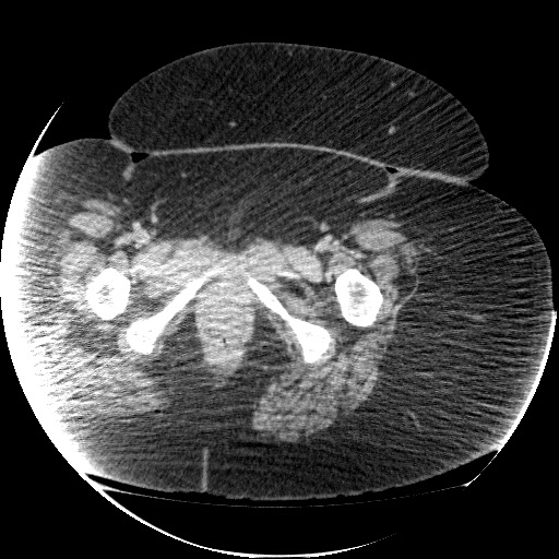 File:Collection due to leak after sleeve gastrectomy (Radiopaedia 55504-61972 A 84).jpg