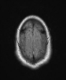 File:Colloid cyst (Radiopaedia 44510-48181 Axial FLAIR 26).png