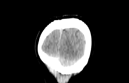 Colloid cyst (Radiopaedia 88663-105373 Coronal non-contrast 65).jpg