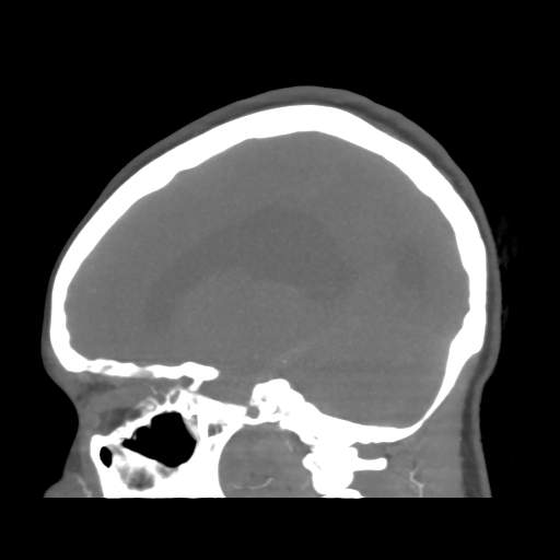 File:Colloid cyst (resulting in death) (Radiopaedia 33423-34499 B 22).png