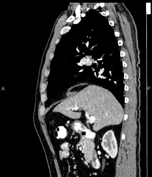 Colon adenocarcinoma (Radiopaedia 83266-97671 D 43).jpg