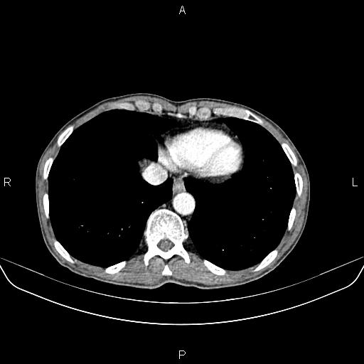 Colon adenocarcinoma - hepatic flexure (Radiopaedia 85635-101395 A 9).jpg